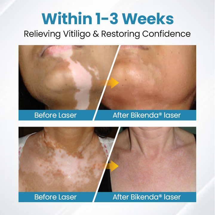 Bikenda® DermaBeam Vitiligo Therapy Device💎