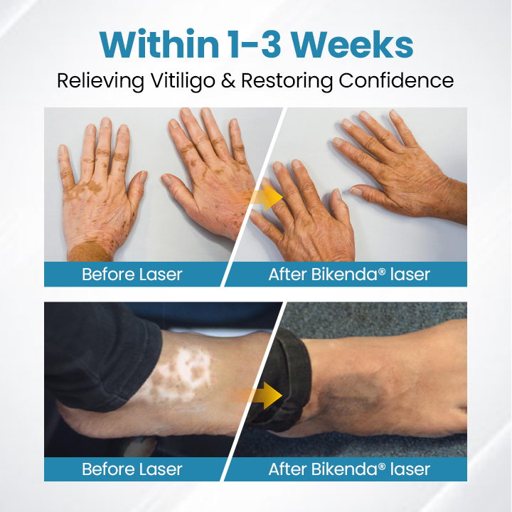 Bikenda® DermaBeam Vitiligo Therapy Device💎