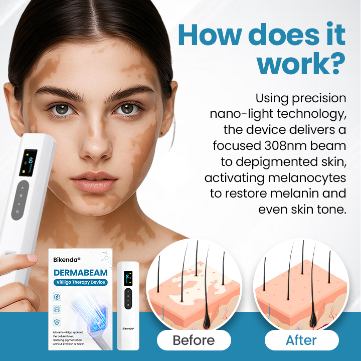 Bikenda® DermaBeam Vitiligo Therapy Device💎