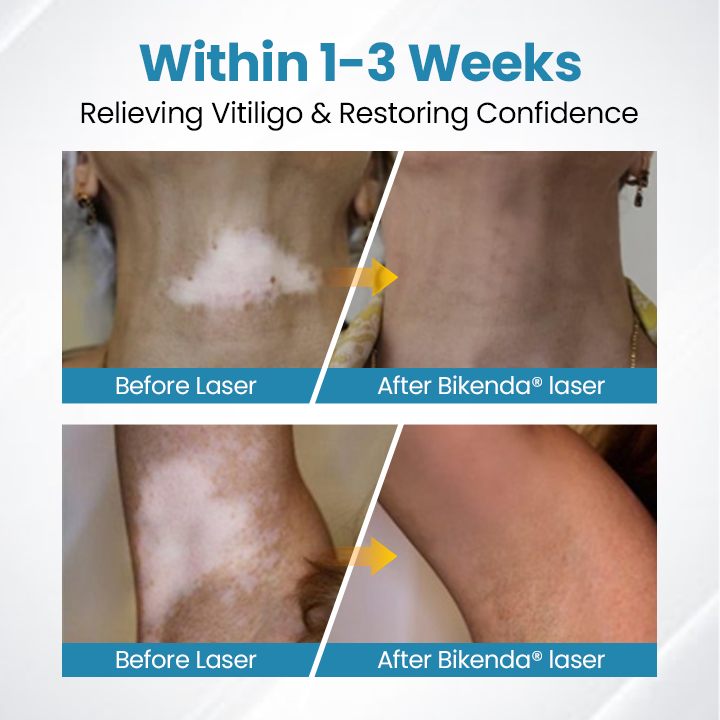 Bikenda® DermaBeam Vitiligo Therapy Device💎