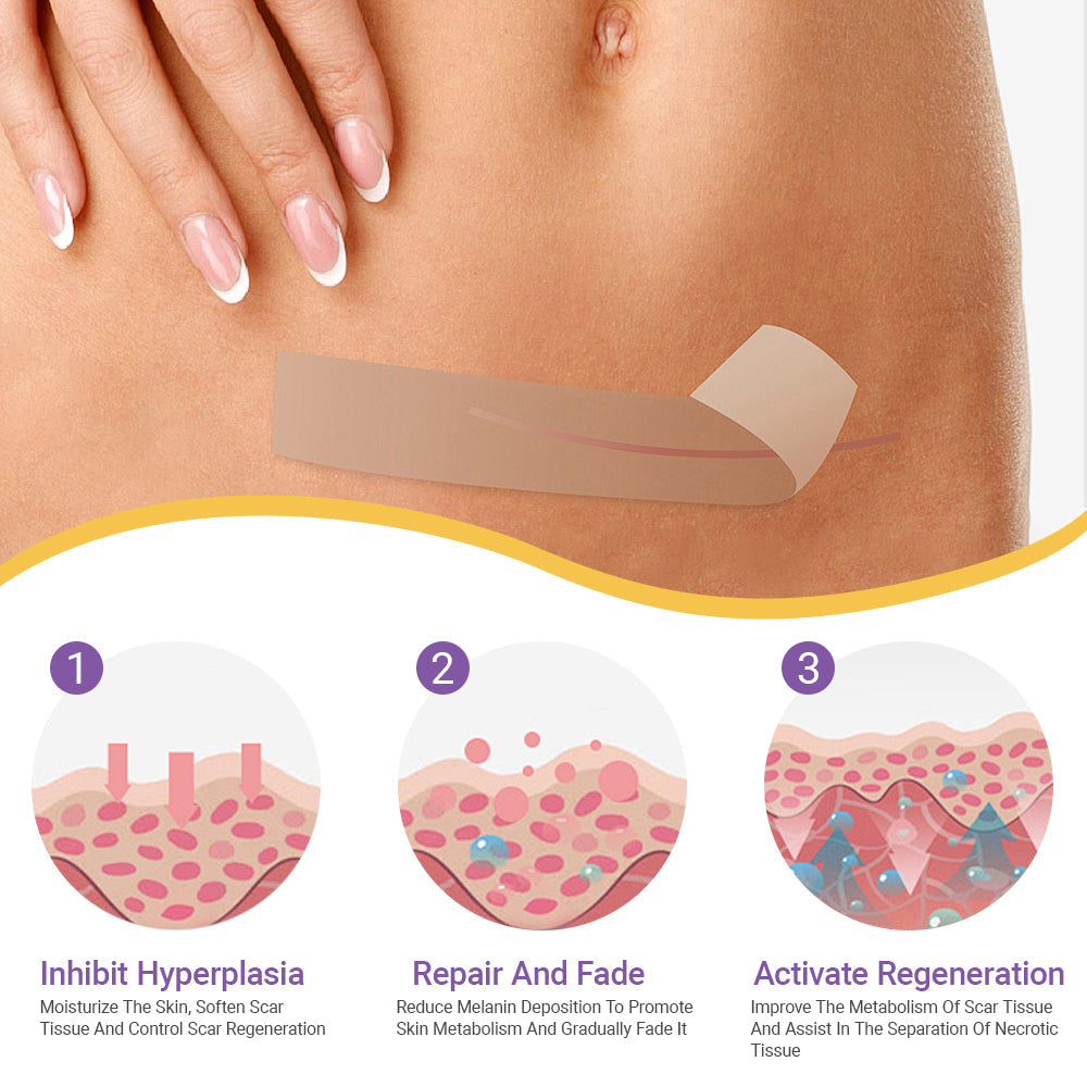 ✅Official Store |𝖤𝖰𝖵𝖯® Hyaluronic Acid Nano Microneedle Repair Tape 🏥(Treatment of old and new scars, reduction of surgical scars, stretch marks, keloids, acne, burns, warts, dermatomes and varicose veins)