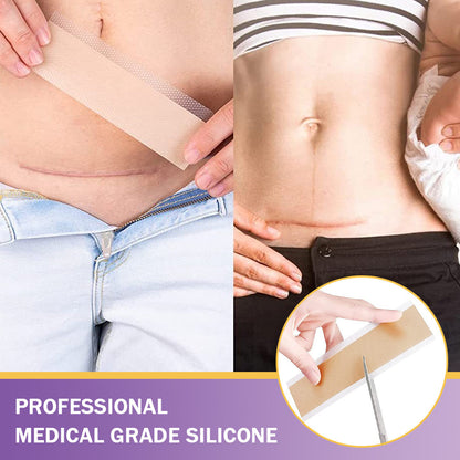 ✅Official Store |𝖤𝖰𝖵𝖯® Hyaluronic Acid Nano Microneedle Repair Tape 🏥(Treatment of old and new scars, reduction of surgical scars, stretch marks, keloids, acne, burns, warts, dermatomes and varicose veins)